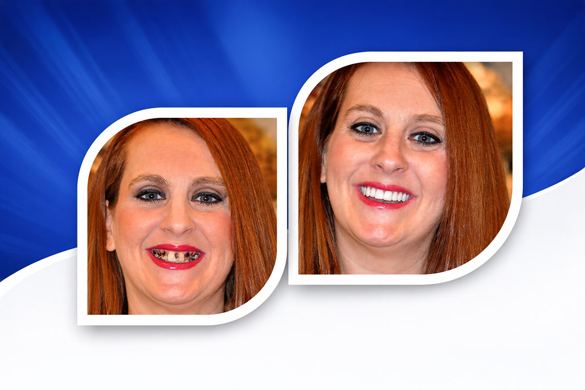 Dental Implants in Vasant Kunj
